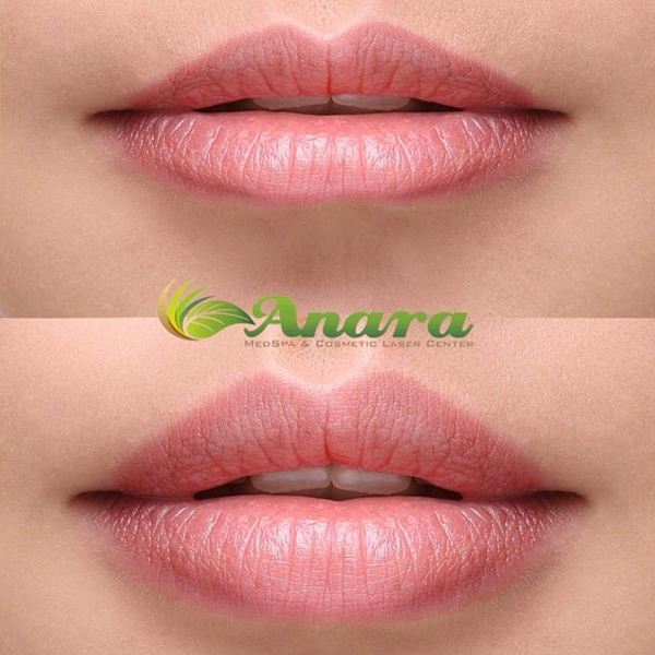 Lip Filler treatment.jpg