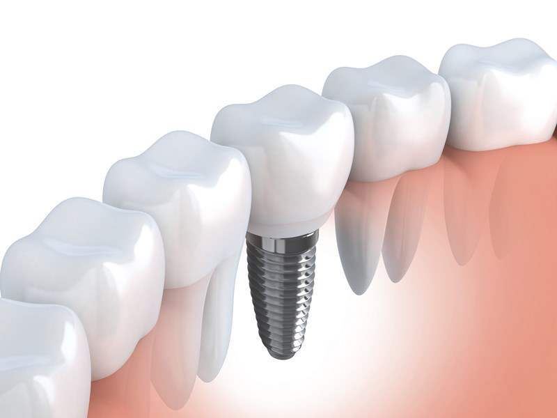 DentalImplants in India.jpg
