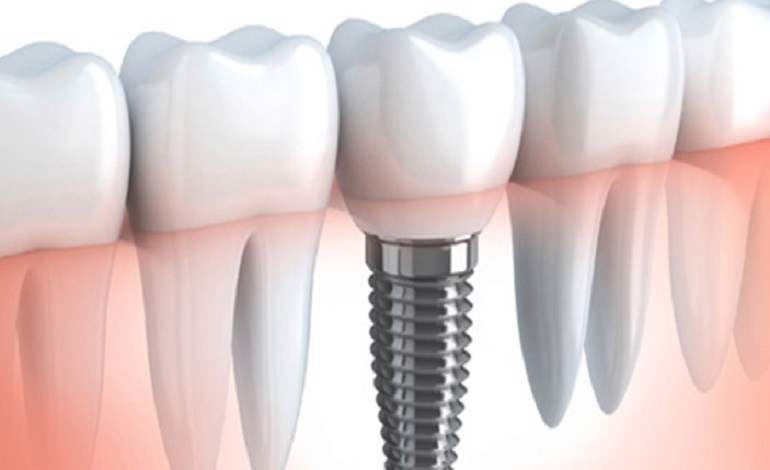 dentalimplants.jpg