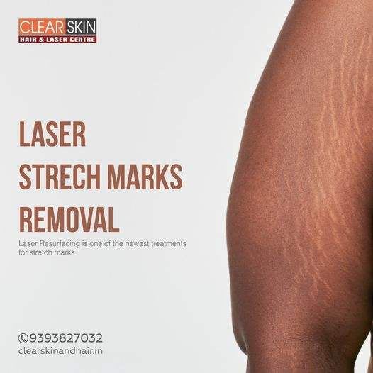 laser stretch marks re.jpg