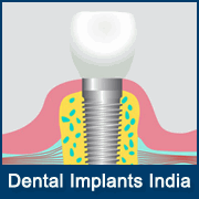dp-dental-implants-india.png