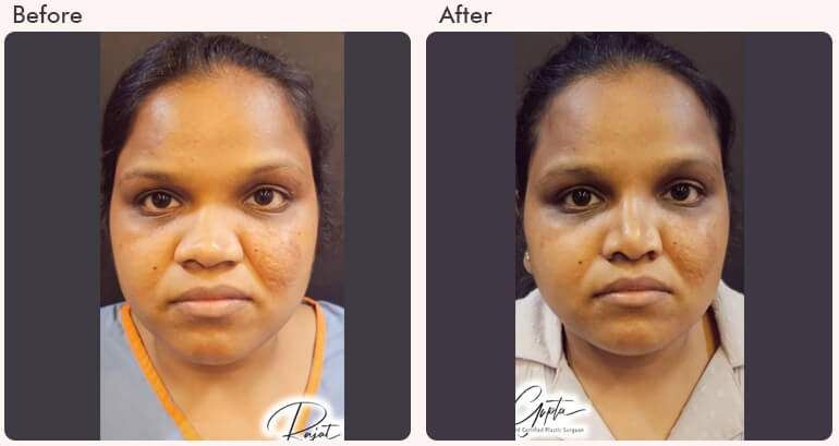 before-after-result-rhinoplasty-01.jpg