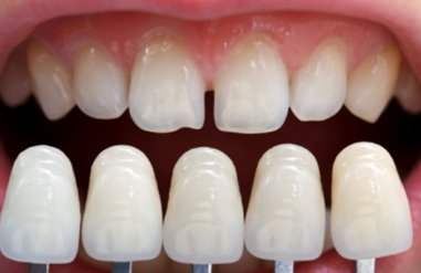 dental-veneers.jpg