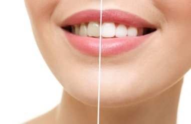 teeth-whitening.jpg