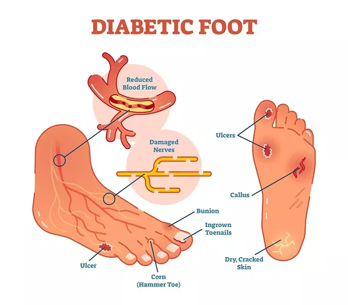 Illustration-of-diabetic-foot-with-ulcers.jpg