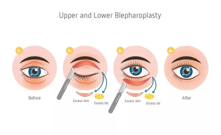 Blepharoplasty-Procedure.jpg