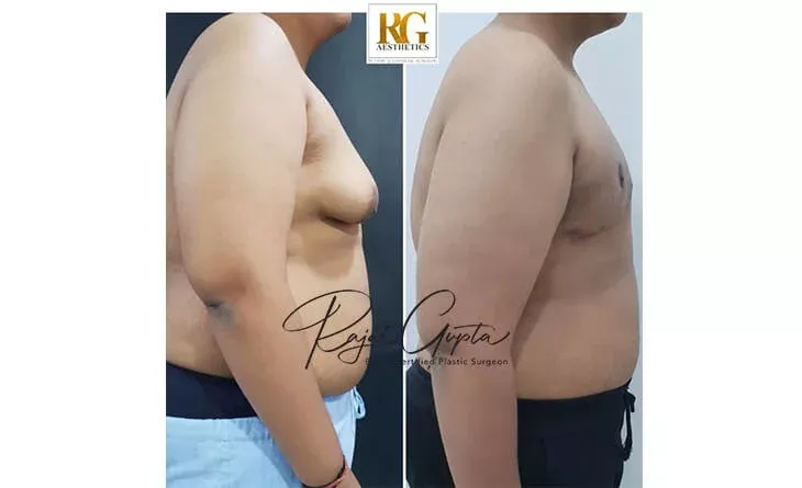 Gynecomastia-Surgery-Before-and-After-Result-Dr-Rajat-Gupta-Plastic-Surgeon-in-Delhi-RG-Aesthetics-01.jpg