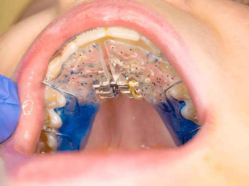 jaw expanders for adults.jpg