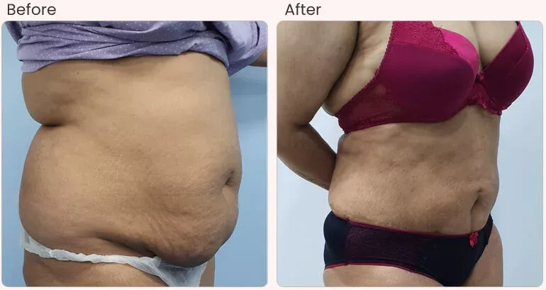 before-after-result-liposuction-02.jpg