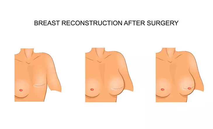 The-Impact-of-Breast-Reconstruction-Surgery-on-Self-Esteem-Dr-Rajat-Gupta-Plastic-Surgeon-in-Delhi-01.jpg