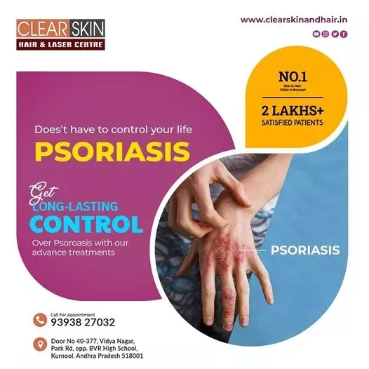 psoriasis treatment.jpg