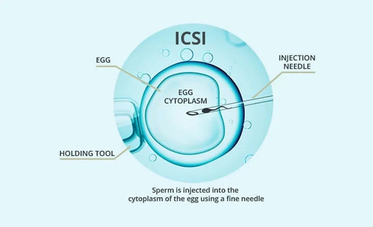 Why-is-ICSI-Treatment-Done-Dr-Rhythm-Gupta-Excel-IVF.jpg