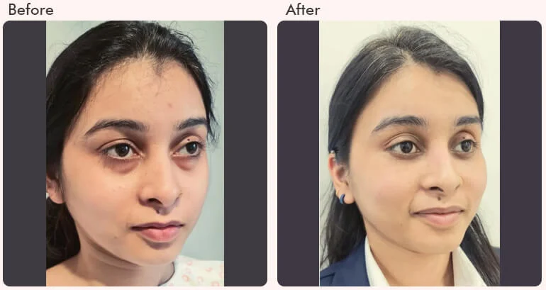 before-after-result-Blepharoplasty-03.jpg