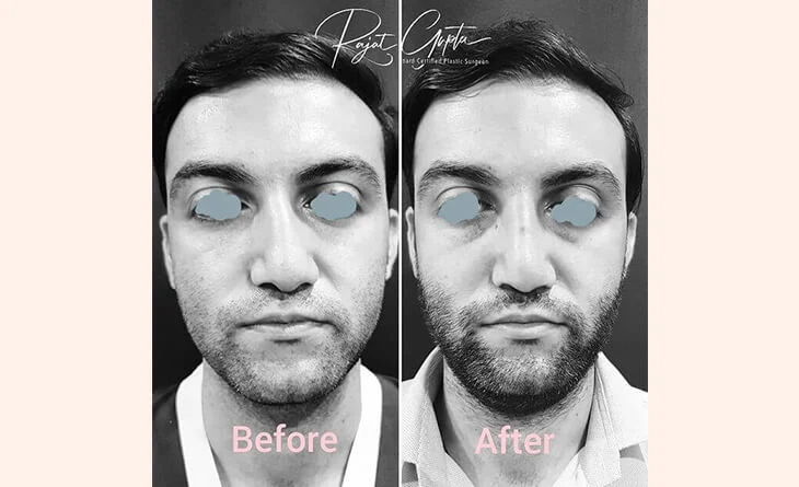What-Are-Rhinoplasty-Grafts-and-Why-Are-They-Important-Dr-Rajat-Gupta-Plastic-Surgeon-in-Delhi-02.jpg