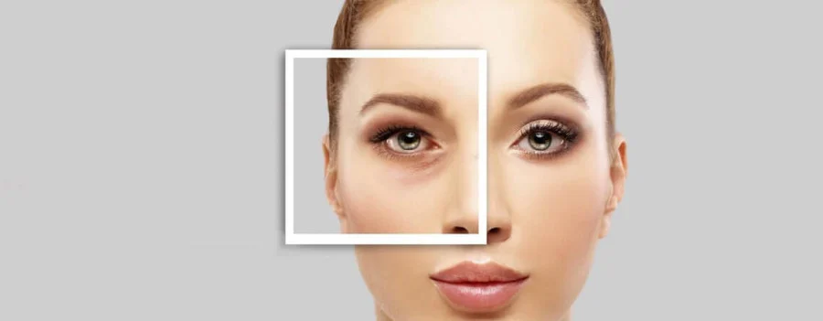 Who-is-an-Ideal-Candidate-for-Lower-Blepharoplasty-Surgery-Dr-Rajat-Gupta-Plastic-Surgeon-in-Delhi-02.jpg