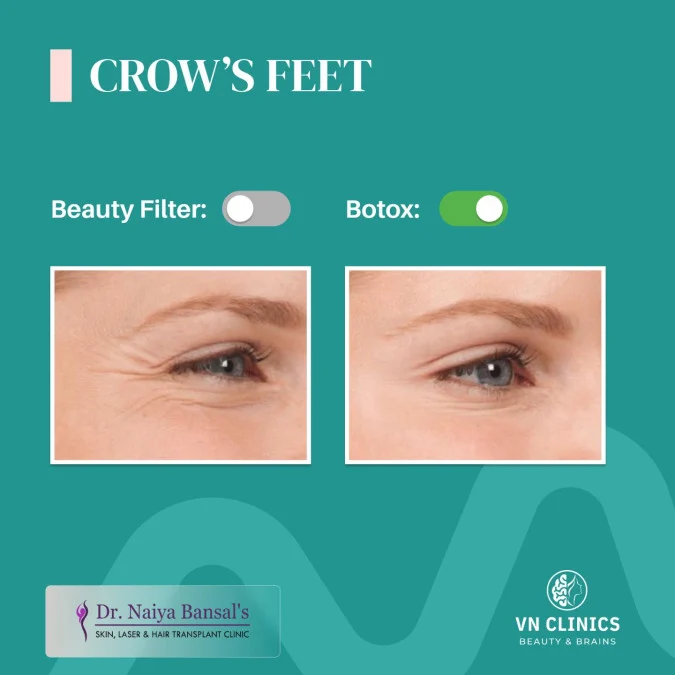 Dr Naiya bansal - Botox treatment in Mohali.jpg