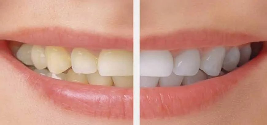 dental-bleaching1 (1) (1).jpg