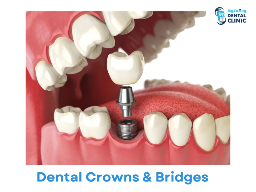 Dental Crowns & Bridges-dental clinic in karve nagar- My Family Dental Clinic.png