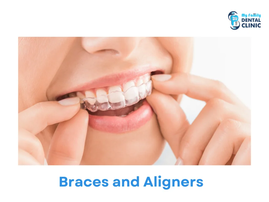 Braces and Aligners -dental clinic in karve nagar- My Family Dental Clinic.png