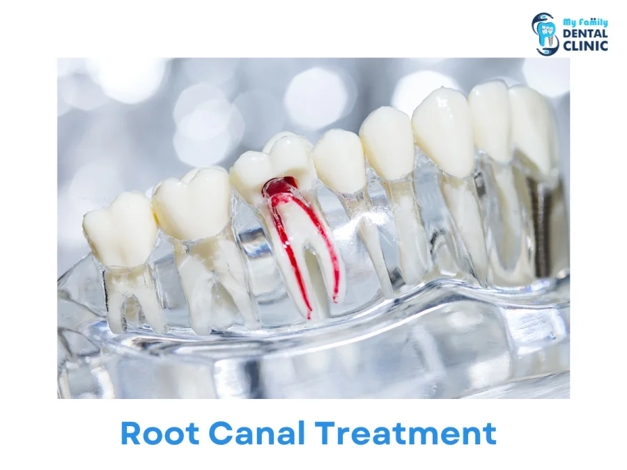 Root Canal Treatment-My Family Dental Clinic -Pune.png