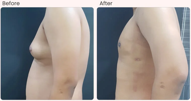 before-after-result-Gynecomastia-03.jpg