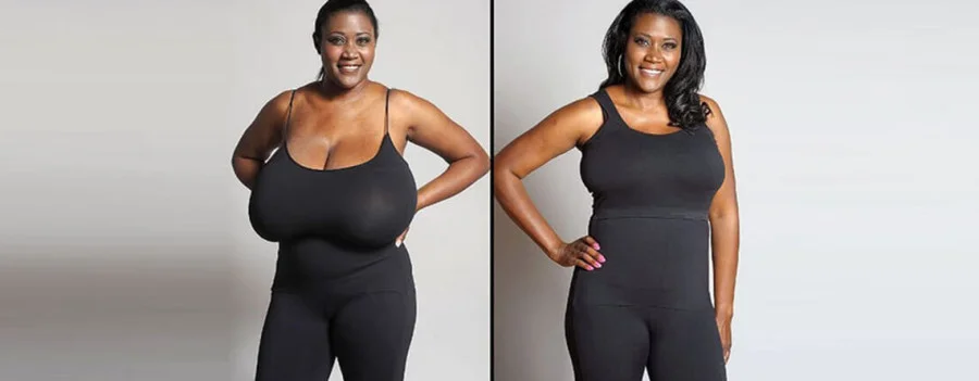 Breast-Reduction-Surgery-RG-Flap-Technique-Surgery-Dr-Rajat-Gupta-Plastic-surgery-specialist-Delhi-RG-Aesthetics (1).jpg