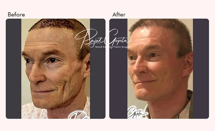 Facelift-Surgery-Before-and-After-Facelift-Surgery-in-Delhi-Dr-Rajat-Gupta-Plastic-Surgeon-in-Delhi.jpg
