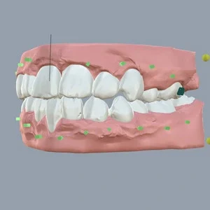 Cross-Bite-Teeth-after.jpg