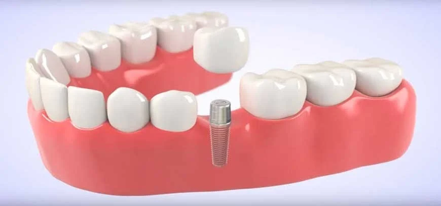 dental-implantsA.jpg