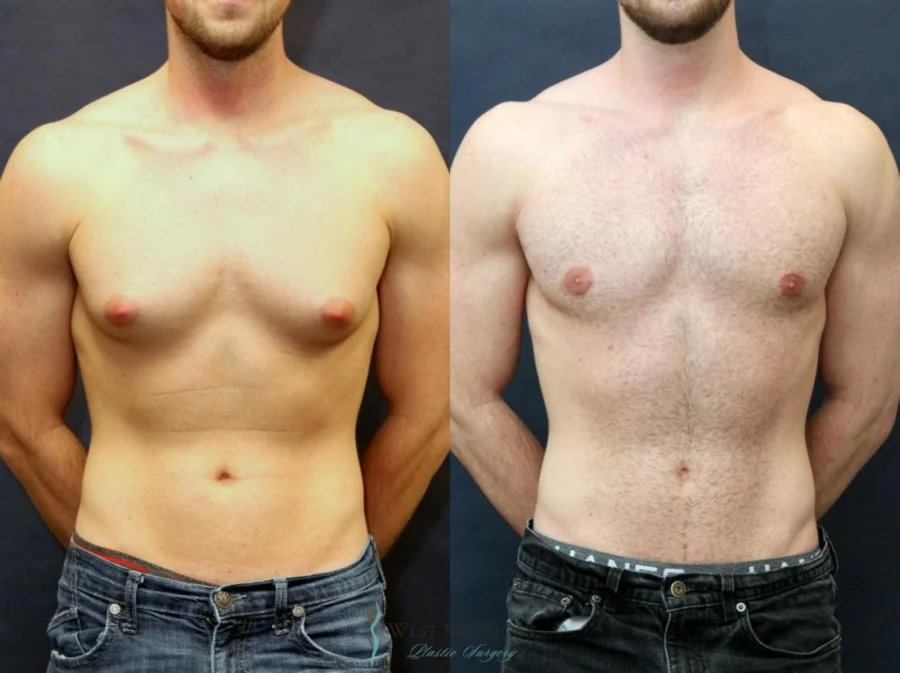 Gynecomastia Surgery in Delhi NCR.jpg