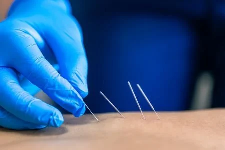 dry-needling.jpg