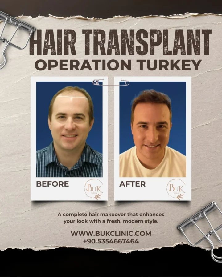 Hair Transplant Operation Turkey .jpg