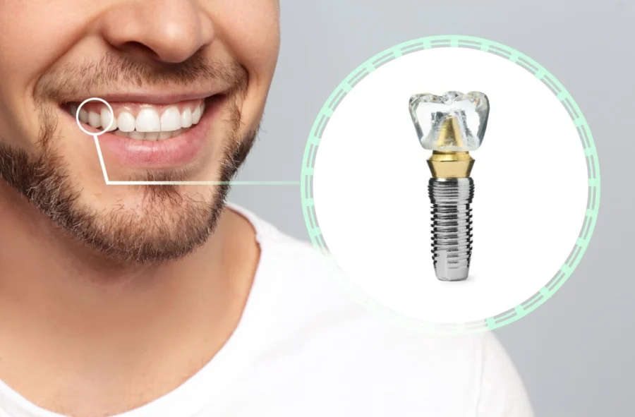 how-long-can-dental-implants-last.jpg