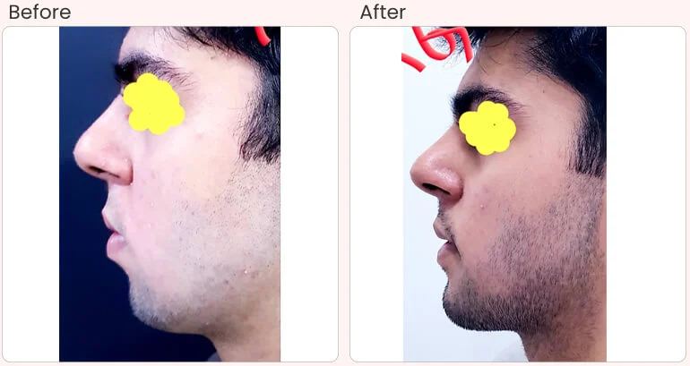 before-after-treatment-chin-augmentation-087.jpg