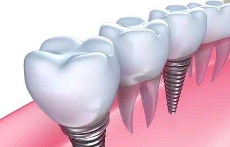 dental implants_the affordable dentist sydney.jpg