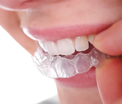 invisible braces_the affordable dentist sydney.jpg